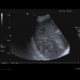 Neuroendocrine tumour of adrenal gland, liver metastasis, necrotic: US - Ultrasound